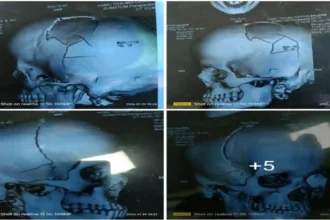 कछौना कांड: लाठियों की बरसात से सिर हुआ चकनाचूर, CT स्कैन रिपोर्ट देख काँप जाएगी रूह...