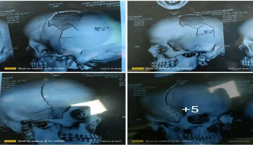 कछौना कांड: लाठियों की बरसात से सिर हुआ चकनाचूर, CT स्कैन रिपोर्ट देख काँप जाएगी रूह...